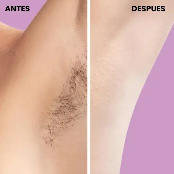 SKINUP™-Depiladora Portátil con tecnología IPL